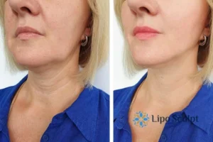 Double chin before and after Hi-Fu treatment 4 Book your double chin treatment Chelmsford today! We are here to help!