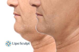 Double chin before and after Hi-Fu treatment 2 Double chin treatment Chelmsford from Lipo Sculpt - feel more confident today!
