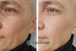 How to Fight Aging Symptoms 3 Fight Aging Symptoms Chelmsford With HIFU and Morpheus8 Today!