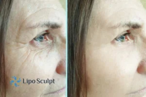 How to Fight Aging Symptoms 2 Do you want to Fight Aging Symptoms Chelmsford? Contact Lipo Sculpt today!