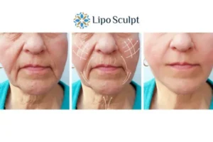 Explaining Morpheus8 And What It Can Do For You 3 Boost your confidence with Morpheus8 Chelmsford call our team today!