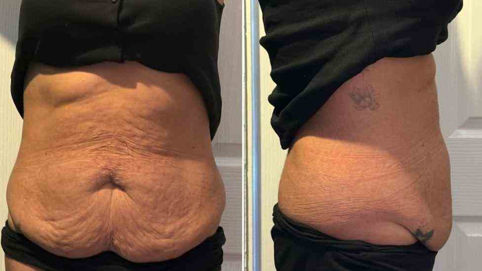 Lost the Weight but Not the Loose Skin? What You Should Know 1 Is It Definitely Loose Skin Chelmsford?