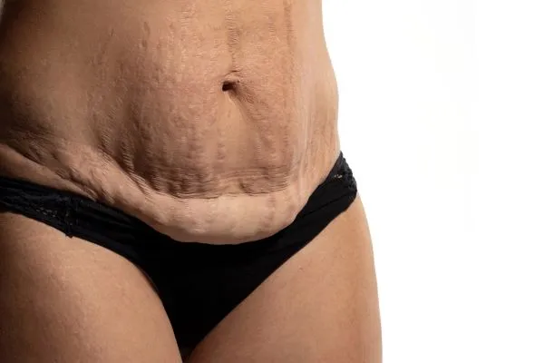 Lost the Weight but Not the Loose Skin? 1 image of womans stomach after weight loss showing loose skin Chelmsford